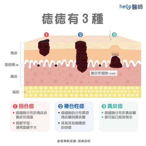 痣的種類|痣形成的原因？痣長毛、痣變多變大是痣病變？5招判。